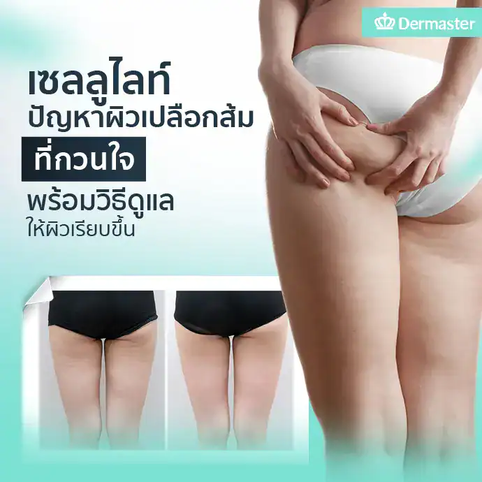 เซลลูไลท์ ปัญหาผิวเปลือกส้มที่กวนใจ พร้อมวิธีดูแลให้ผิวเรียบเนียนขึ้น