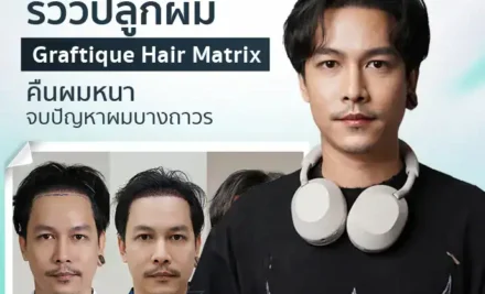 รีวิวปลูกผม Graftique Hair Matrix คืนผมหนา จบปัญหาผมบางถาวร