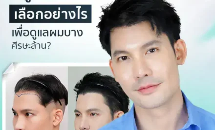 ปลูกผมที่ไหนดี เลือกอย่างไรเพื่อดูแลผมบาง ศีรษะล้าน?