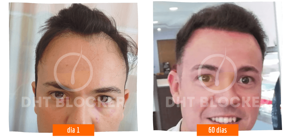 Resultado do tratamento DHT Blocker em homem, com preenchimento visível das entradas e da linha frontal do cabelo.