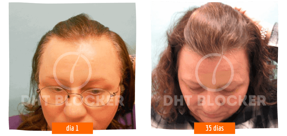 Homem exibe cabelo mais volumoso e com menos falhas no couro cabeludo após usar o tratamento capilar DHT Blocker.