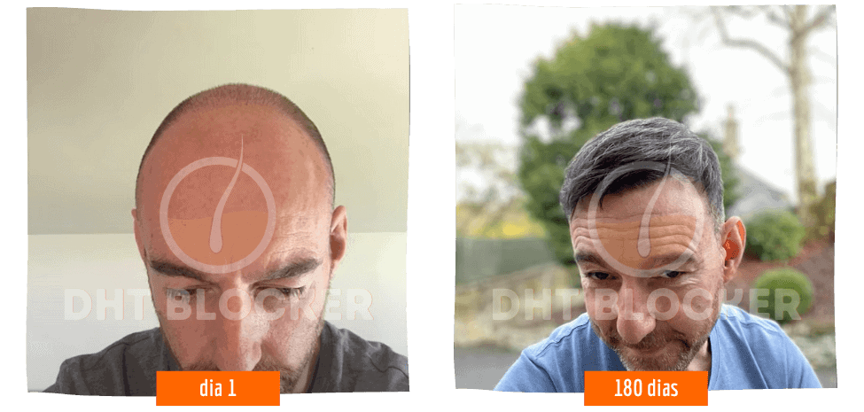 Antes e depois do uso do DHT Blocker, mostrando a recuperação capilar e o preenchimento da coroa (vértice) da cabeça.