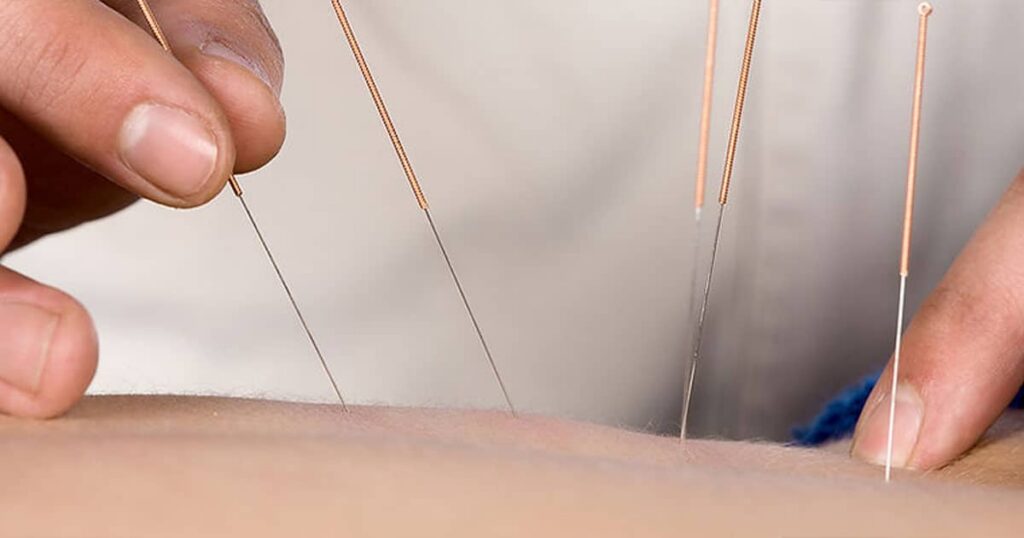 Acupuncture needles inserted for pain relief and healing.