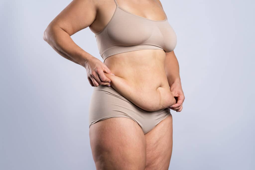 Tummy tuck flabby skin   Dr Yaprak surgeon
