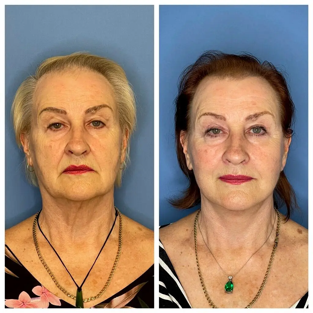 Facelift with Bulent Yaprak   Plastic surgeon