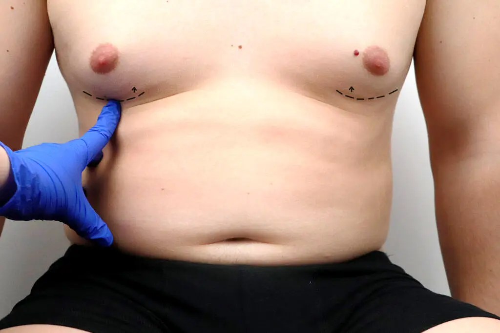 Gynecomastia surgery for men with Bulent Yarpak   man boobs