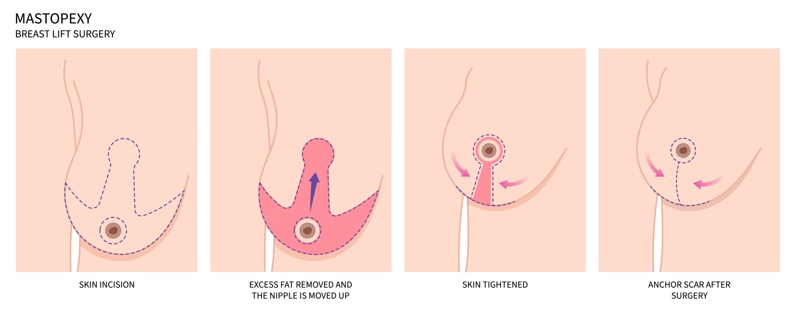 Breast reduction surgery diagram showing incision locations and tissue removal — Dr Bülent Yaprak Hamilton NZ