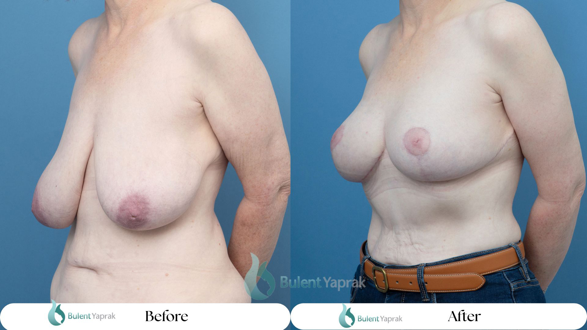 Breast lift mastopexy result — Dr Bülent Yaprak specialist plastic surgeon Hamilton NZ
