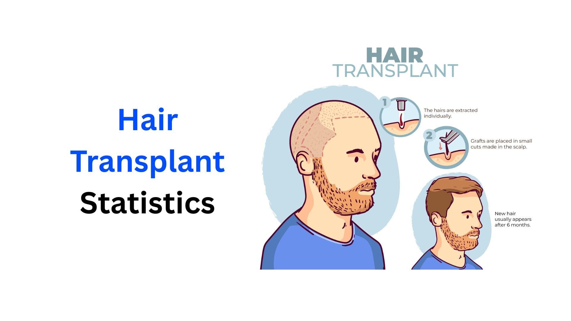Hair Transplant Statistics and Facts 2024