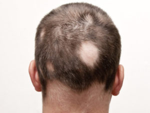 alopecia