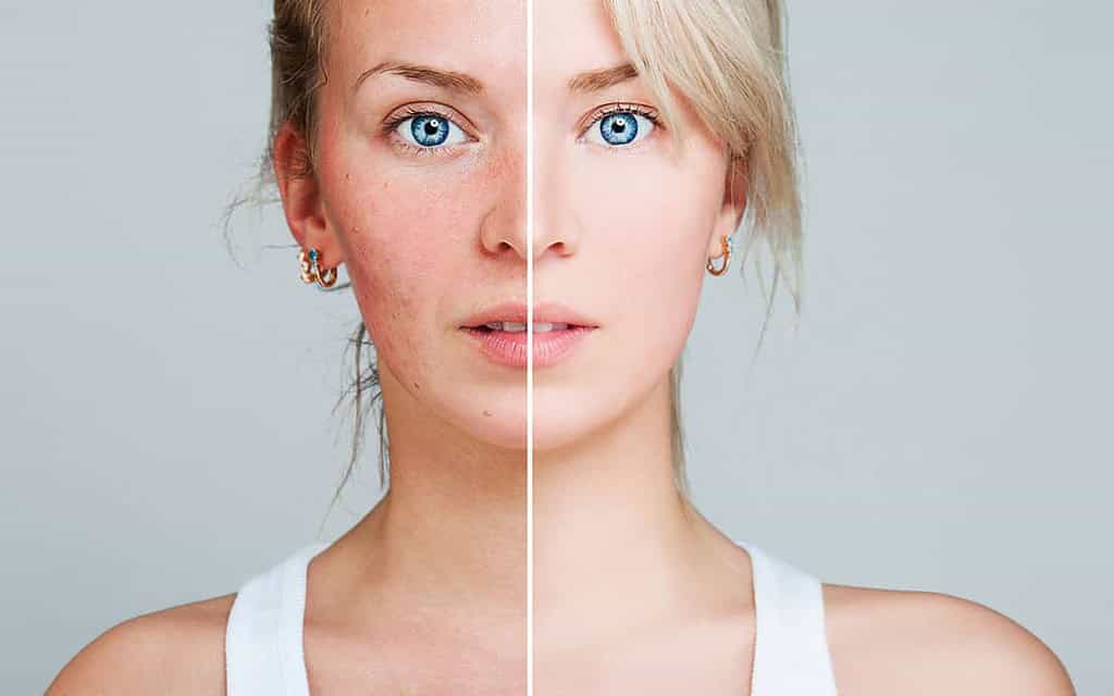 rosacea