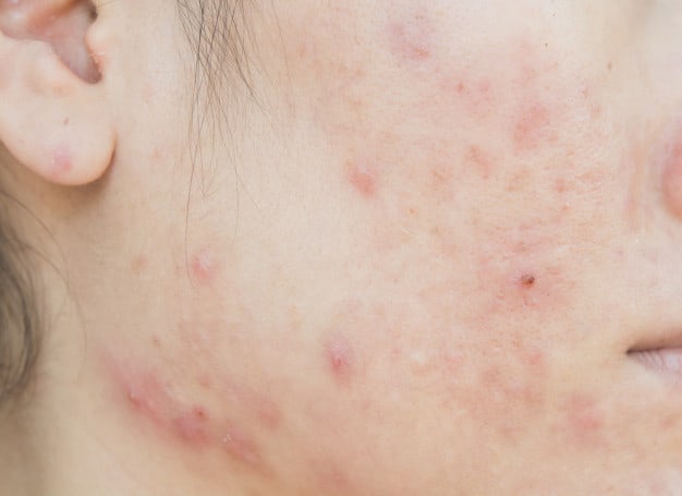 acne
