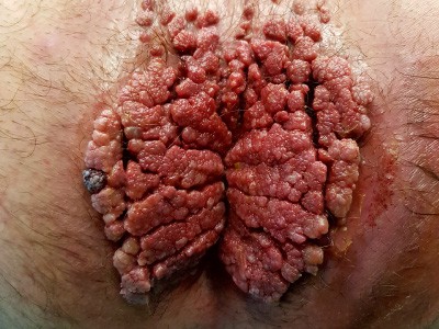 IMG-Infezioni-virali-1