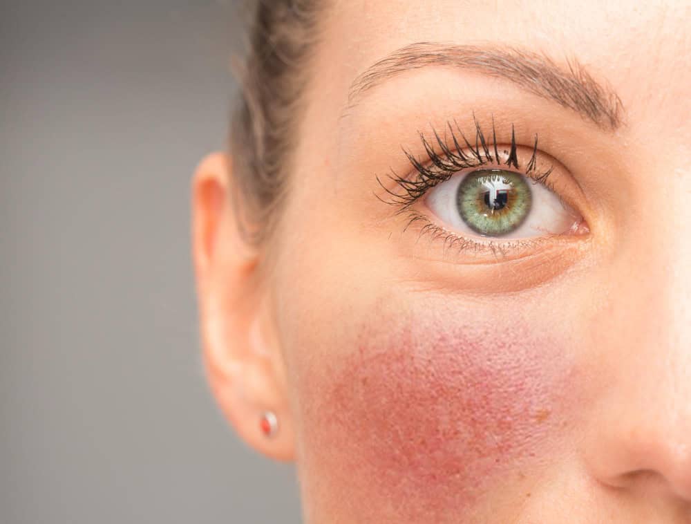 Rosacea  Fairfax, VA 