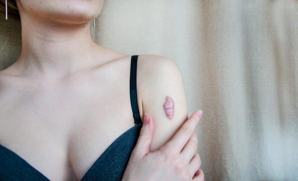 Woman with a skin lesion on her shoulder post-surgical treatment.