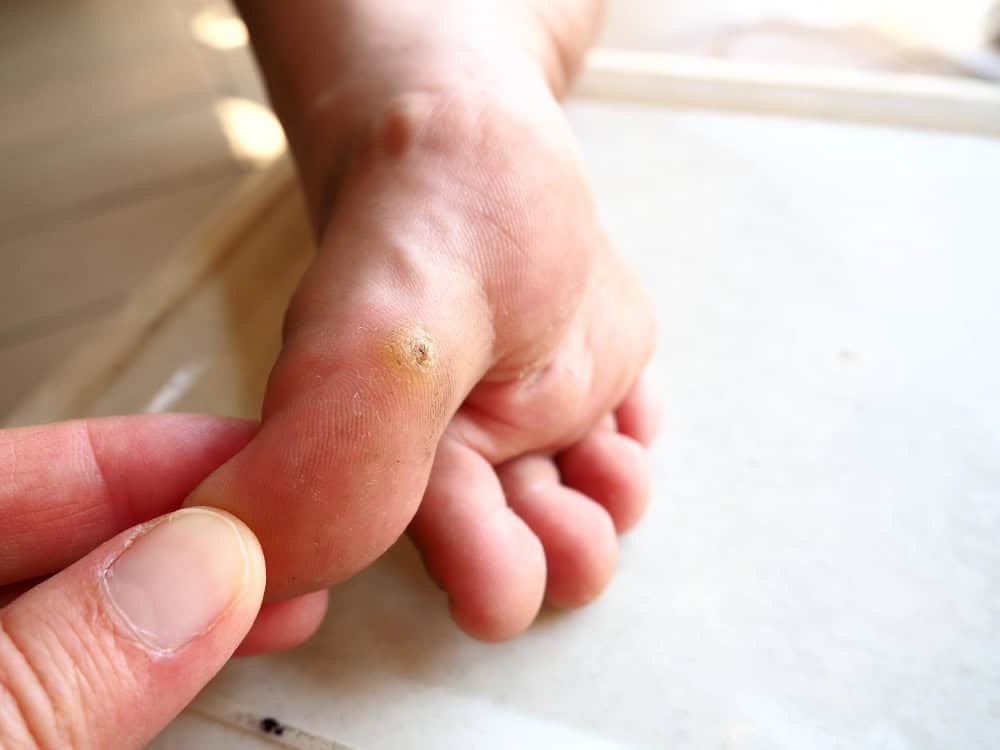 Foot with a plantar wart on the sole, close-up image.
