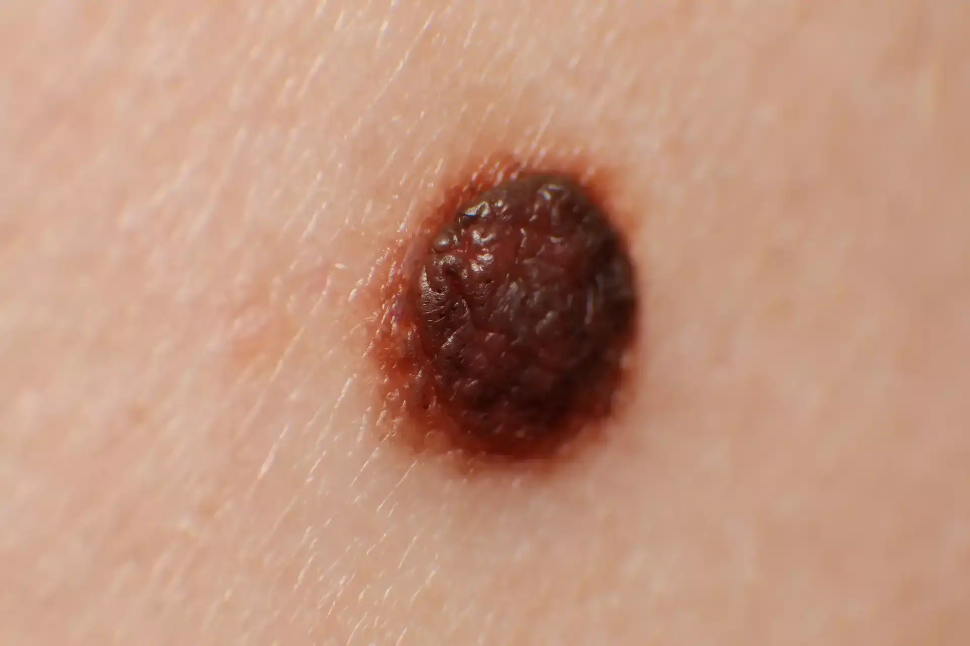 Mole with irregular borders on skin, possibly indicating a skin condition requiring medical evaluati.