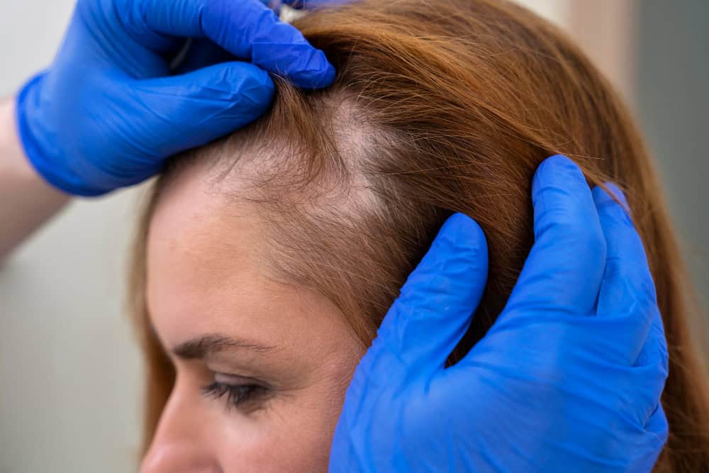 Close-up of a dermatologist examining thinning hair on a woman's scalp with gloved hands.