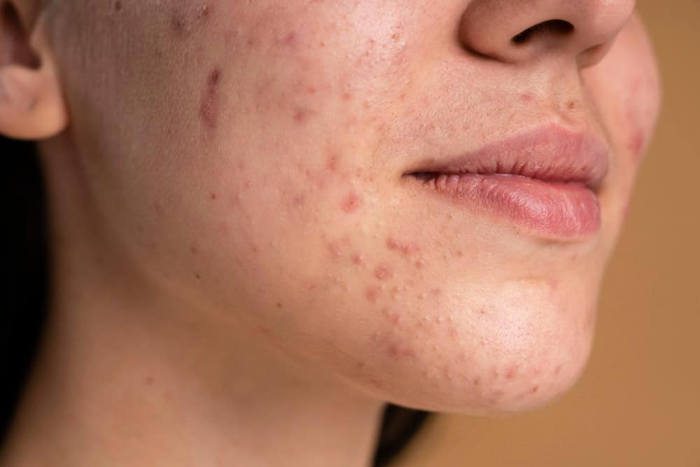 Acne-prone skin with visible pimples and scars on the lower face.