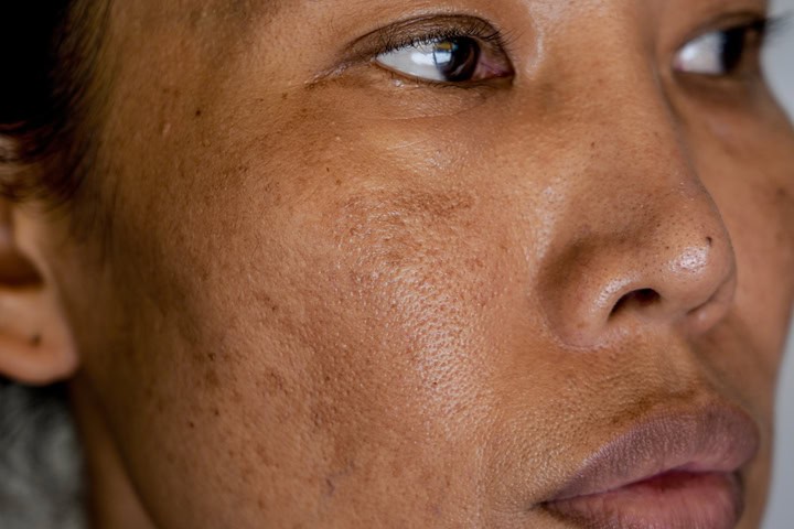 Close-up of a woman's face showing hyperpigmentation and uneven skin tone.