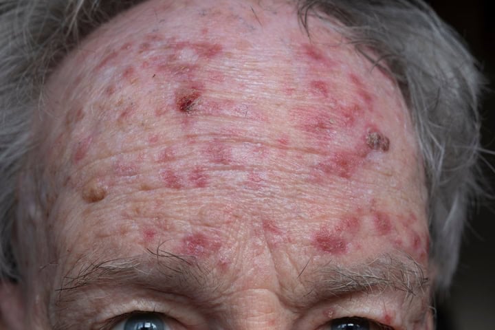 Elderly man with severe facial skin redness, inflammation, and skin lesions.