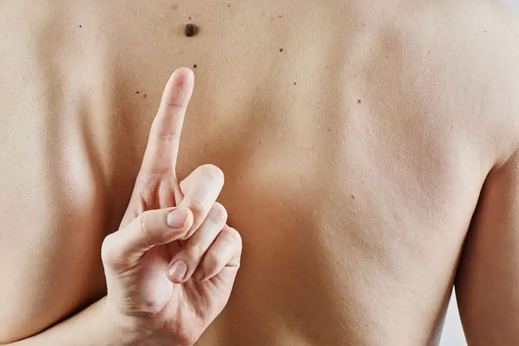 mole removal