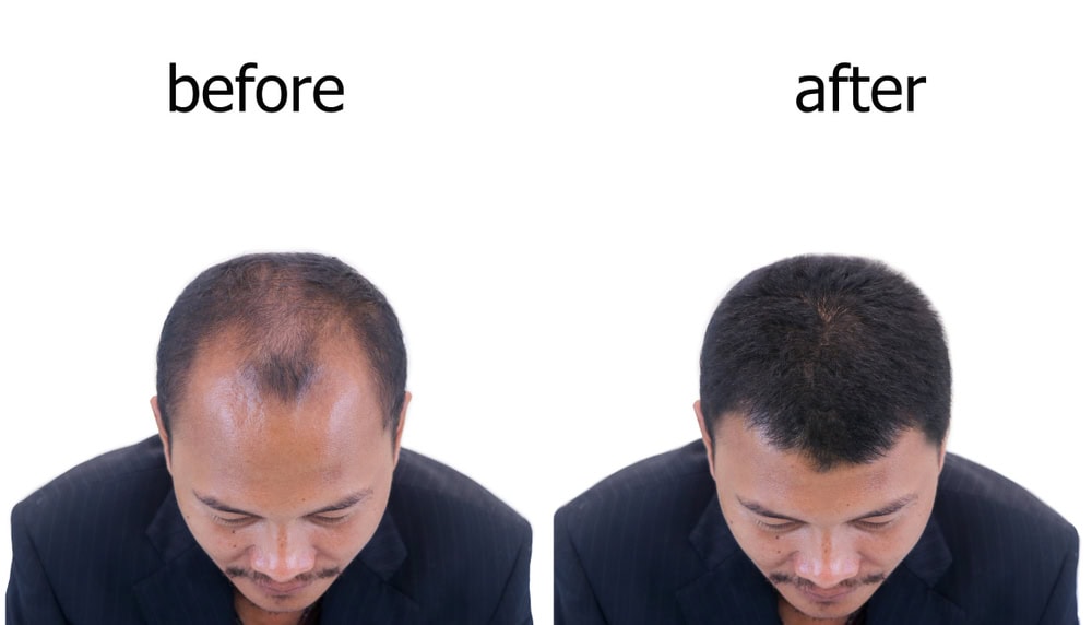 Before,And,After,Bald,Head,Of,A,Man,.