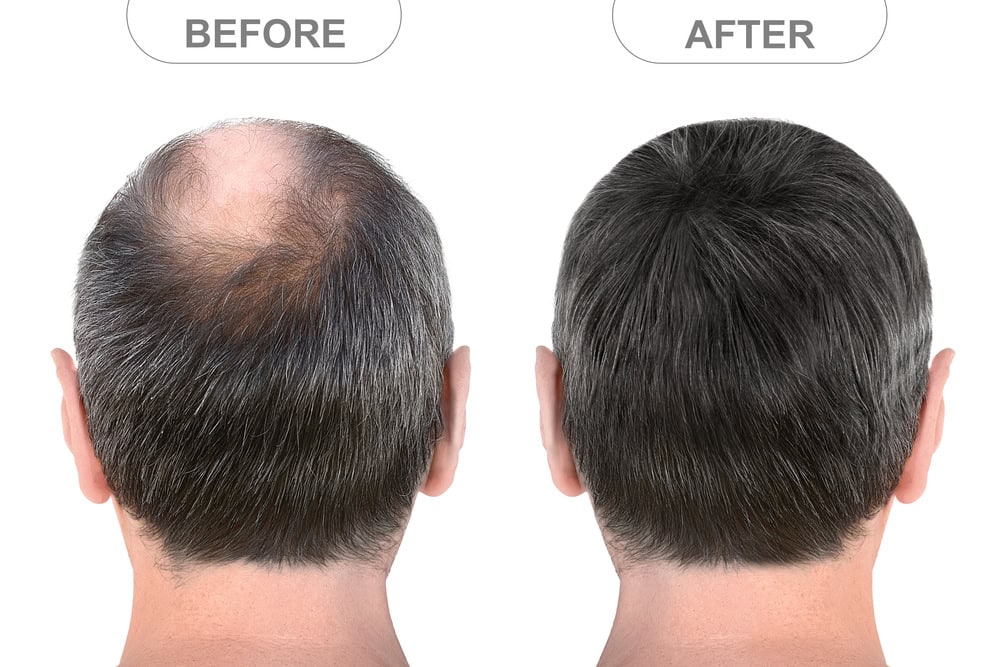 Back,View,Of,Male,Head,Before,And,After,Hair,Extensions