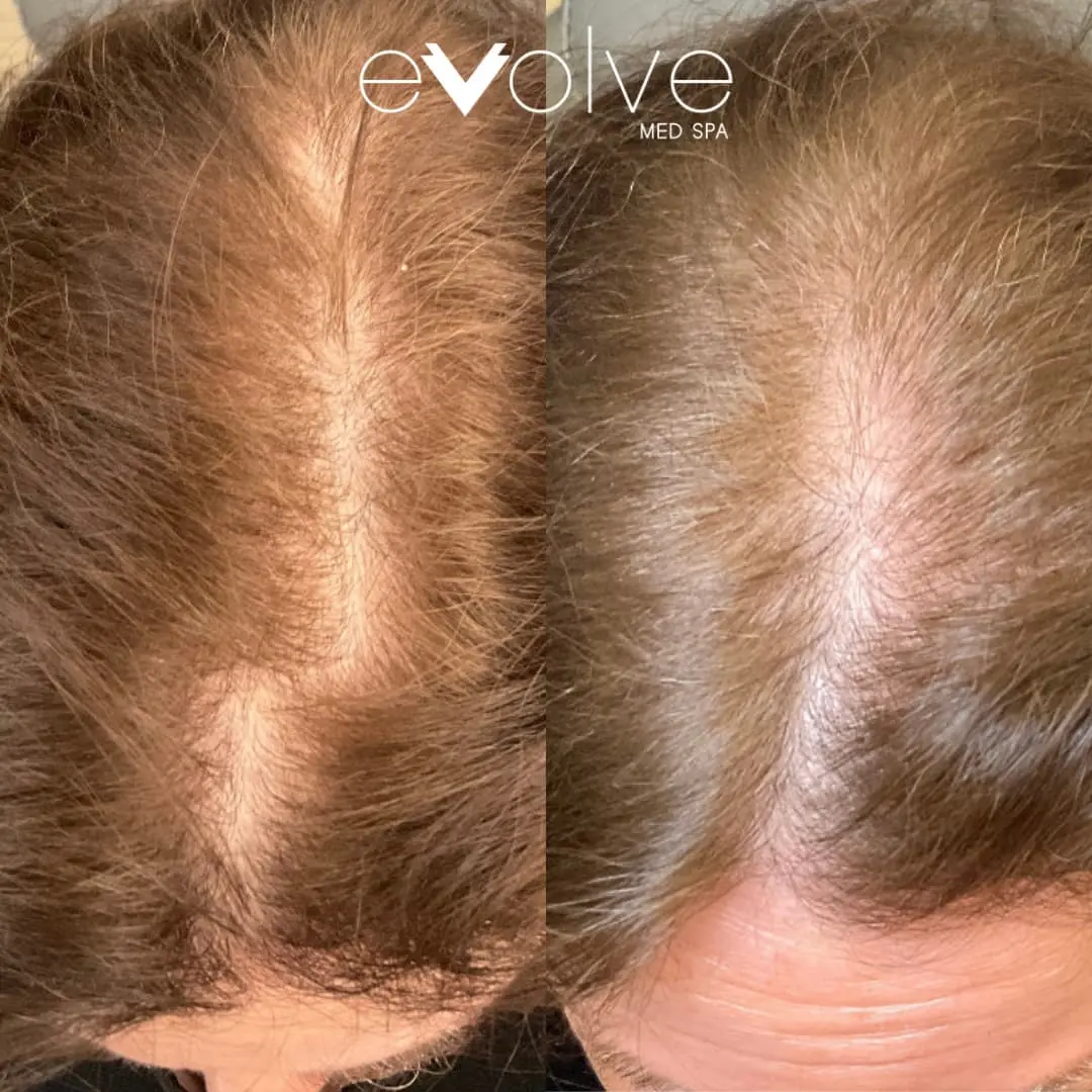 Hairline restored after PRP Hair Rejuvenation