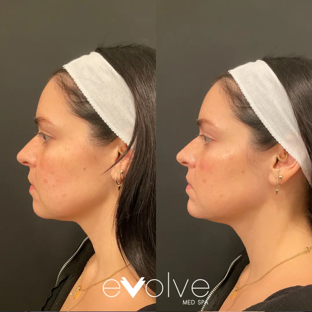 Chin Filler before and after using restylane fillers