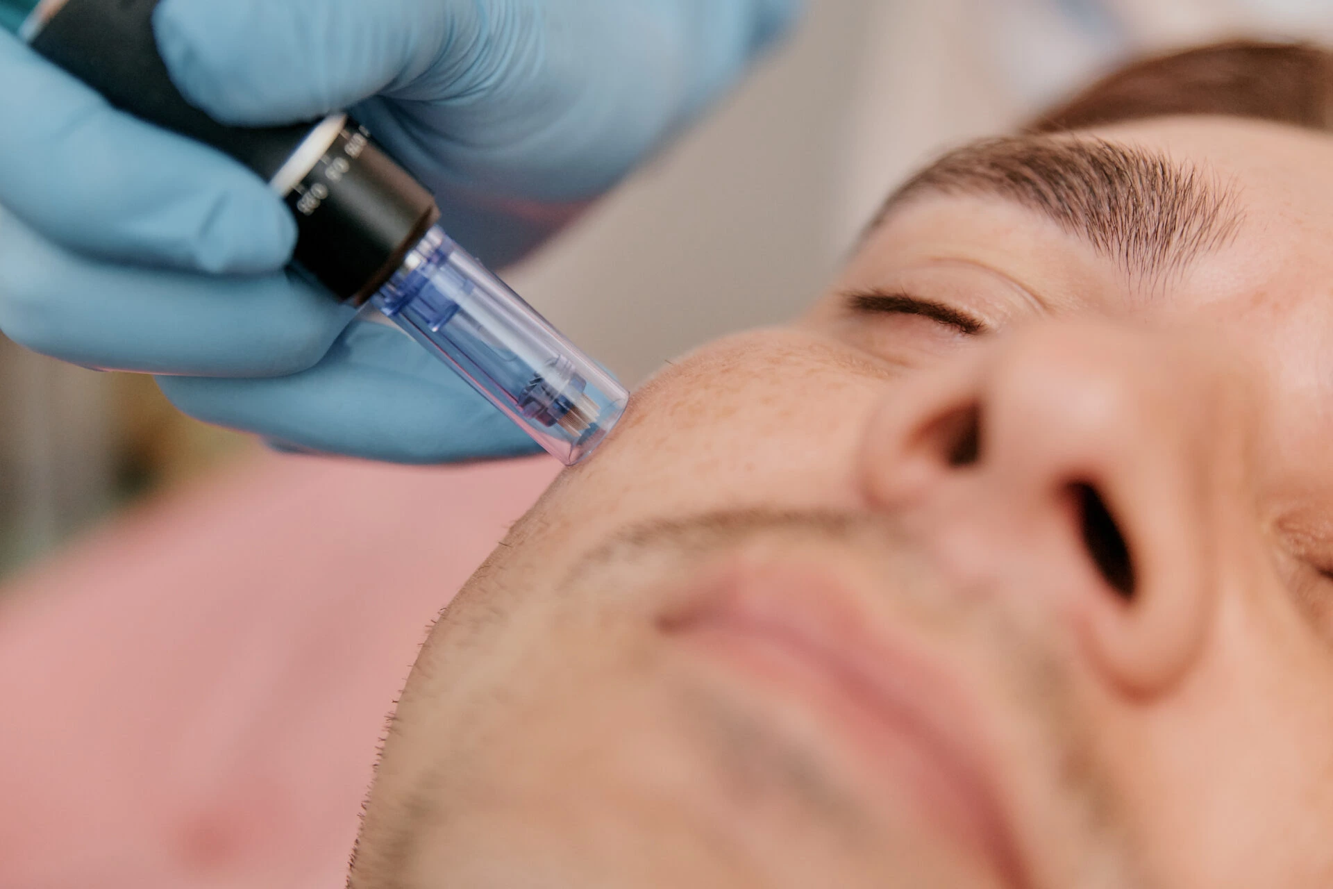 Client receiving microneedling treatment 14 days before botox injection