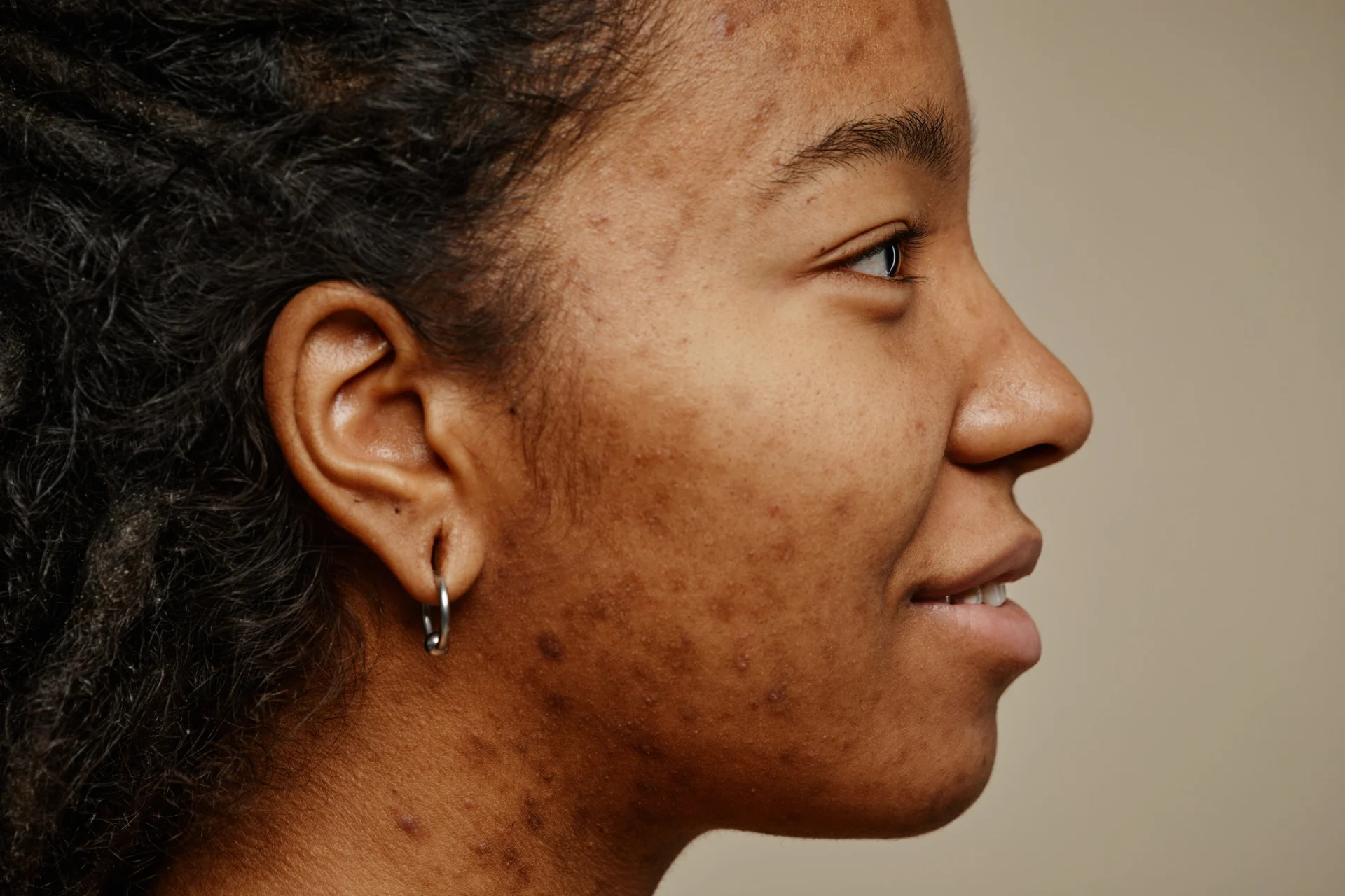 Acne scarring before microneedling on young women's face