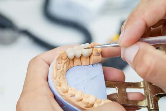 Understanding Dental Bridges: Solutions for Missing Teeth at Heritage Dental Centre 6 Dentist showing client dental bridges