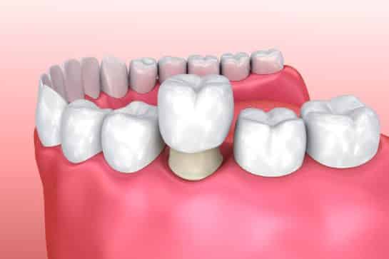 Bottom Teeth Dental Crown