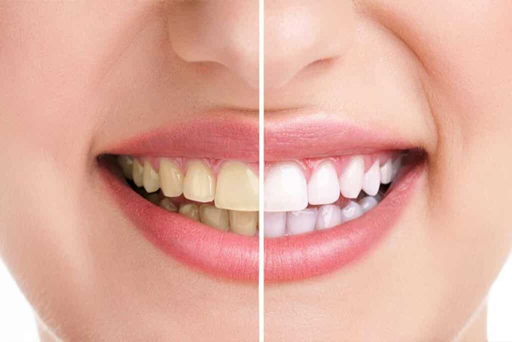 Patient Showing Before And After Of Teeth Whitening Process