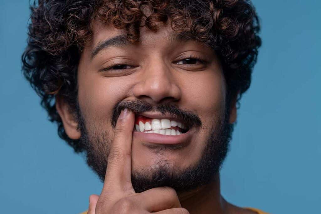 Person Showing Gingivitis