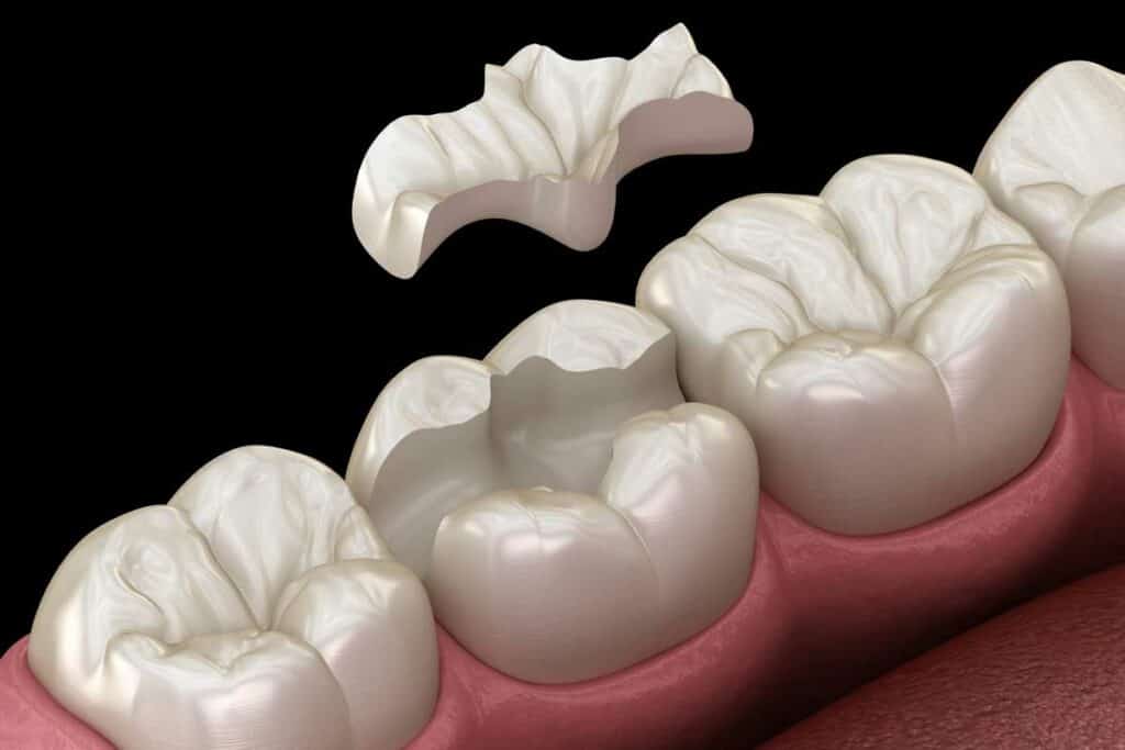Tooth Inlay