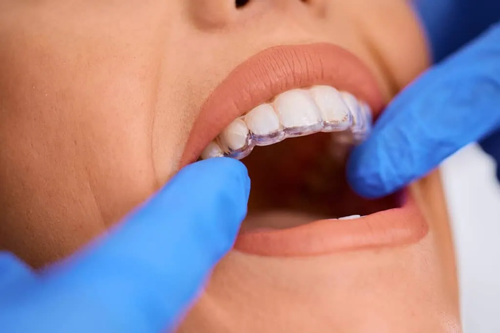 Close-up of a patient with clear dental aligners, dentist examining teeth, orthodontic treatment at Heritage Dental Centre Edmonton.