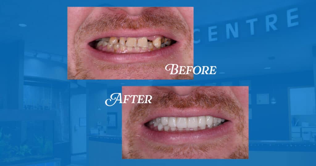 The Complete Guide to Dental Crowns: Restoring Your Smile at Heritage Dental Centre 7 Dental Crowns Edmonton