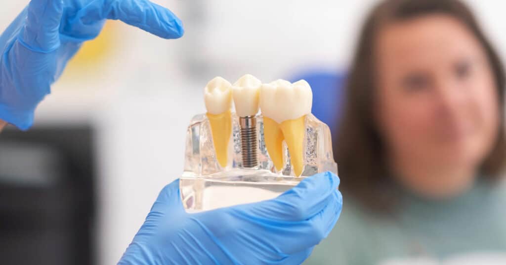 The Importance of Replacing Missing Teeth: Dental Implants vs. Bridges 4 Replacing Missing Teeth