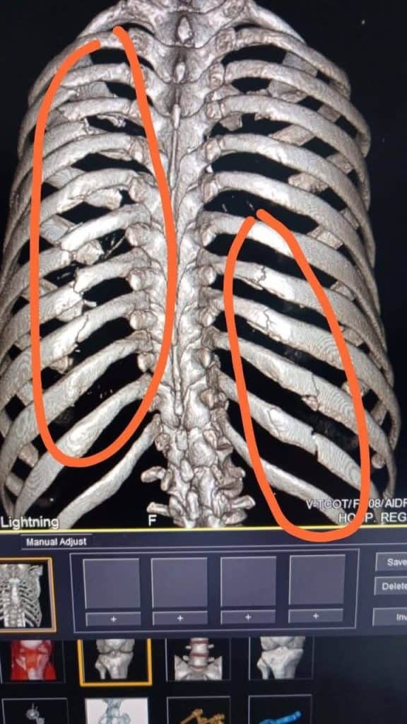 Clavicula y costillas humanas visibles en imagen de radiografía en modelo anatómico.