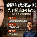 嘴唇有痣想點掉？先看懂這3種情況，再決定要保留還是處理