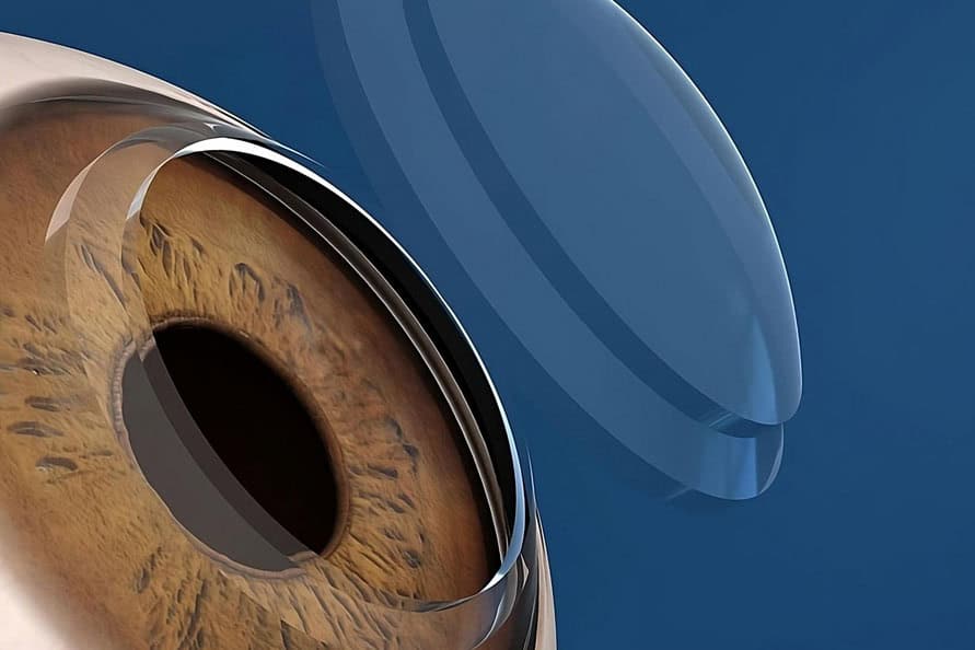 Close-up of a human eye with contact lens, eye health and vision correction by Kerato clinic.