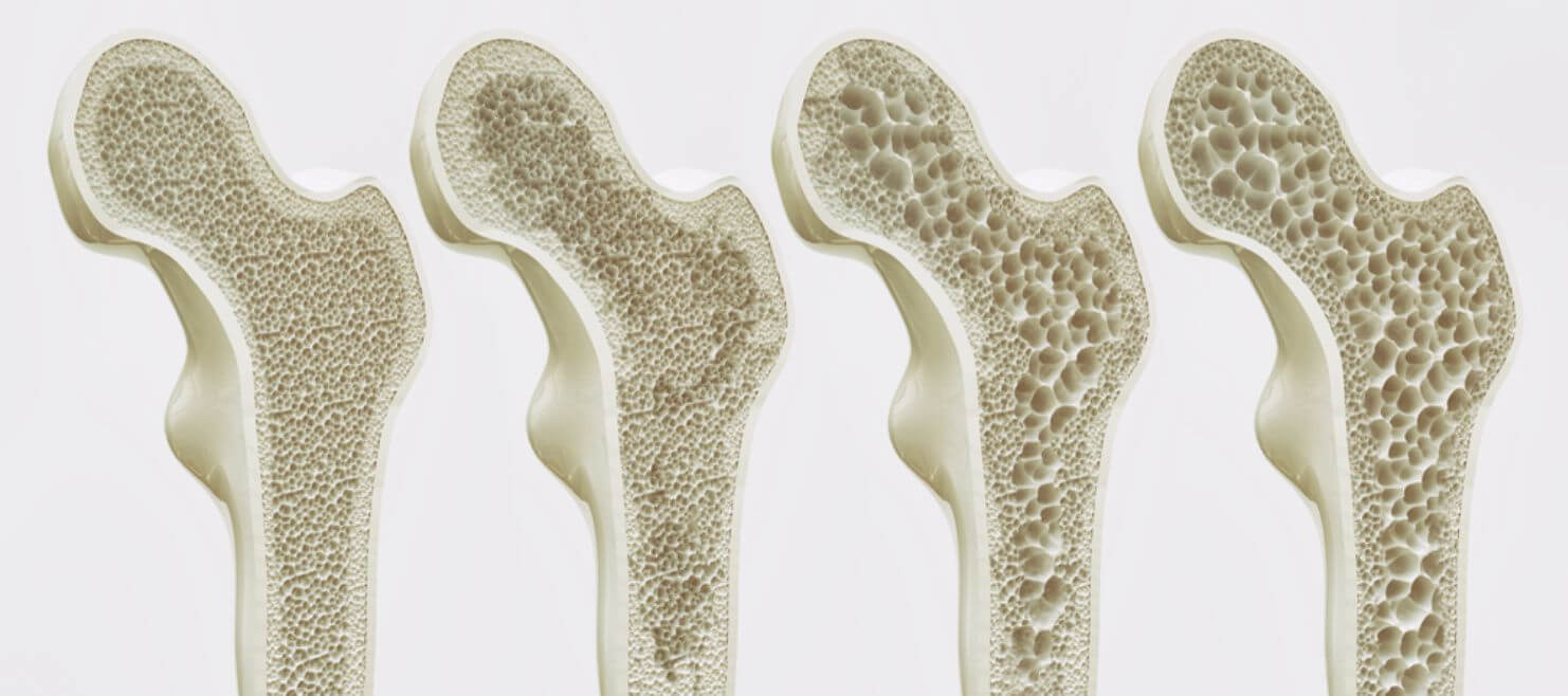 Hegyvidéki osteoporosis klub (HOK)