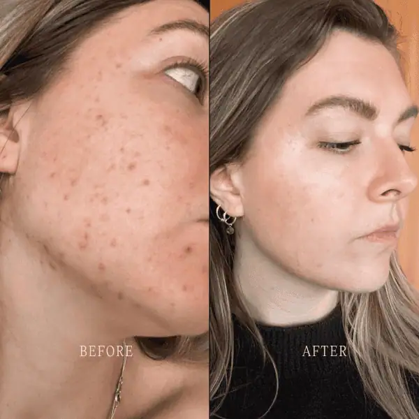 L. Bakker before and after using Loïs Lee The Basics