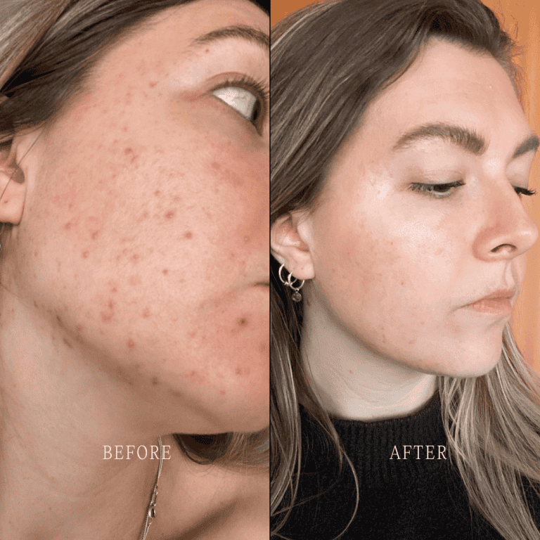 Voor en na foto van Lisa met probleem huid acne en Lisa met stralende huid