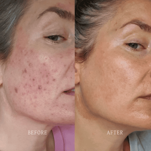 M. Baker before and after using Loïs Lee The Basics