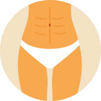 Img-Addominoplastica