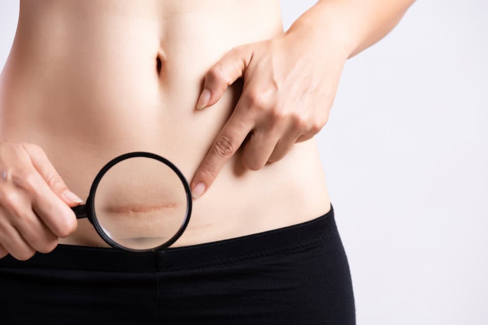 Come ridurre il gonfiore della cicatrice?