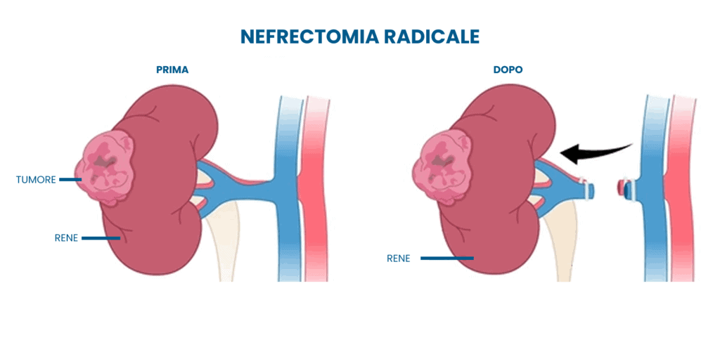 Nefrectomia parziale vs totale